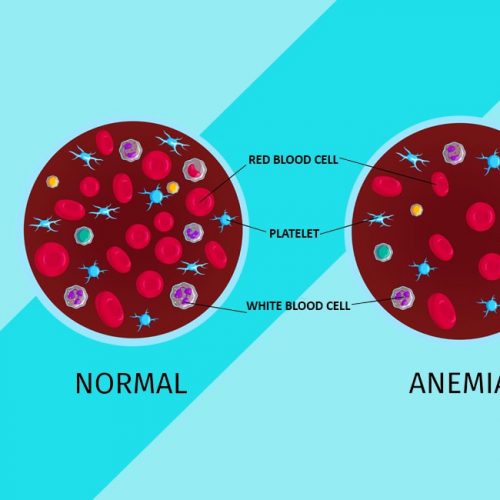 Why Iron Therapy Fails: Unpacking the Challenges in Iron Deficiency Anemia Treatment